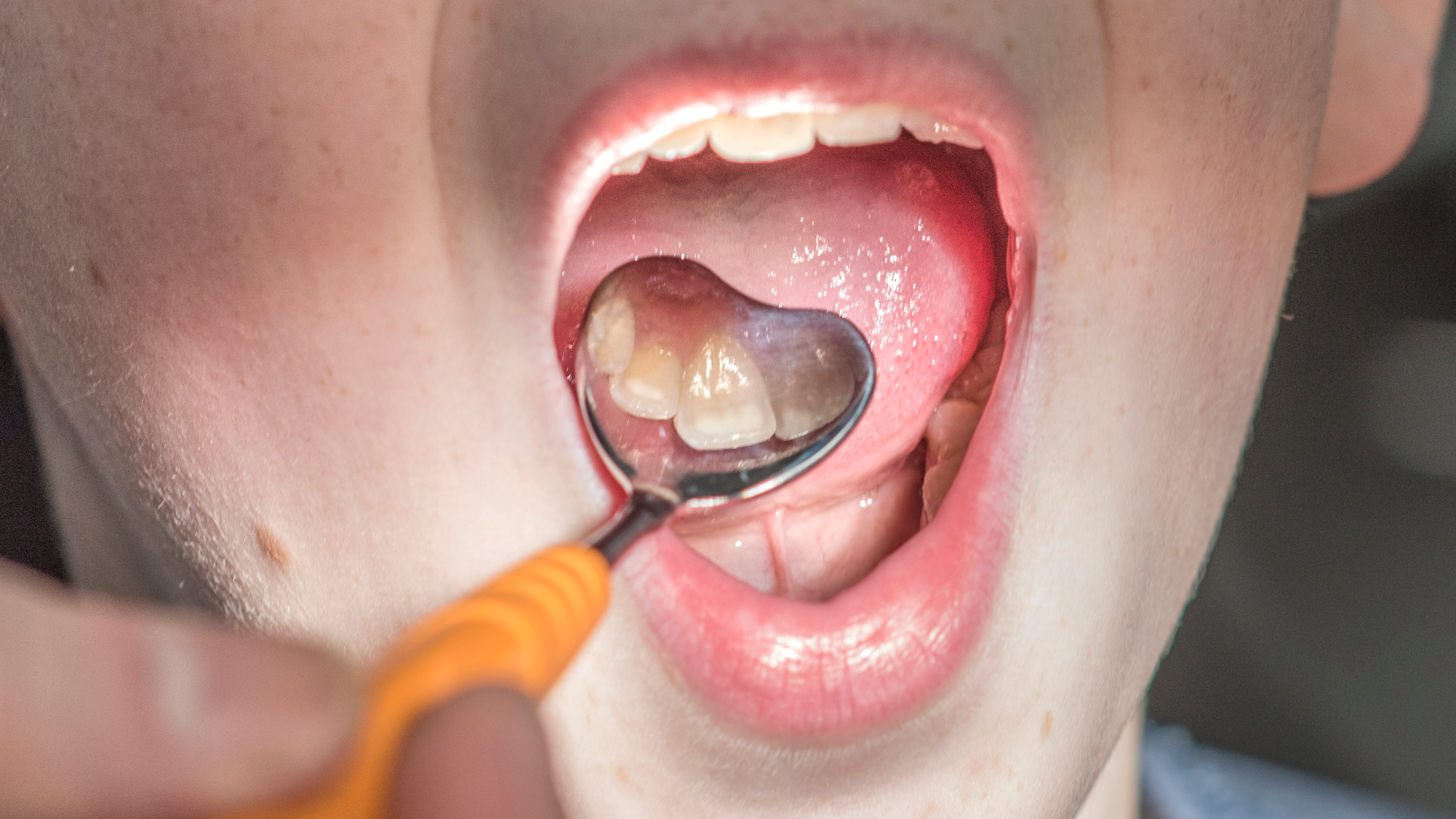 Behandlare använder munspegel för att undersöka en patients tänder