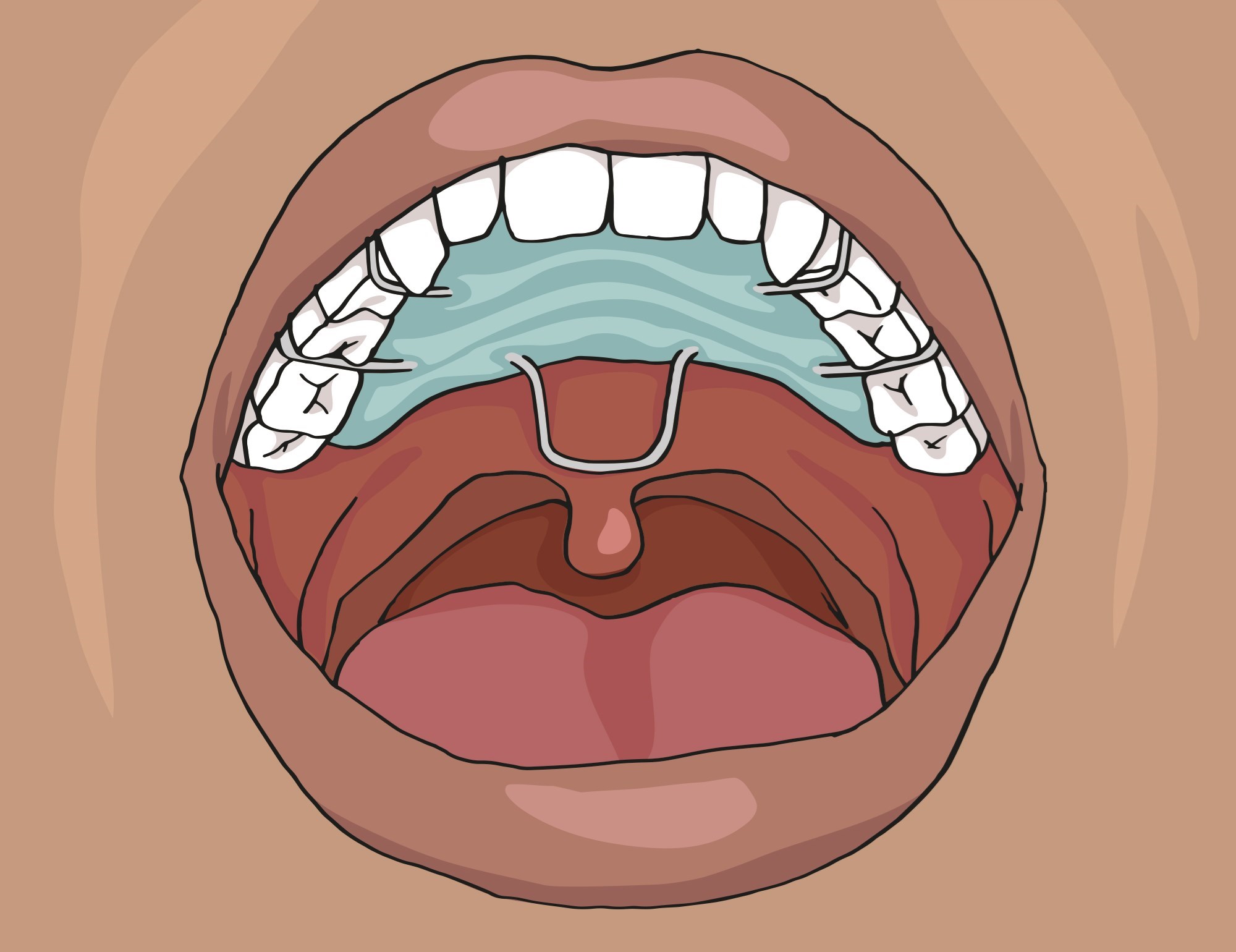 På bilden syns en öppen mun med en gomplatta i gommen. 