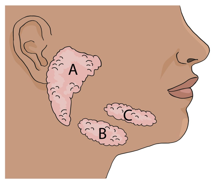 På bilden syns ett ansikte med spottkörtlarna placerade. En anatomisk teckning.